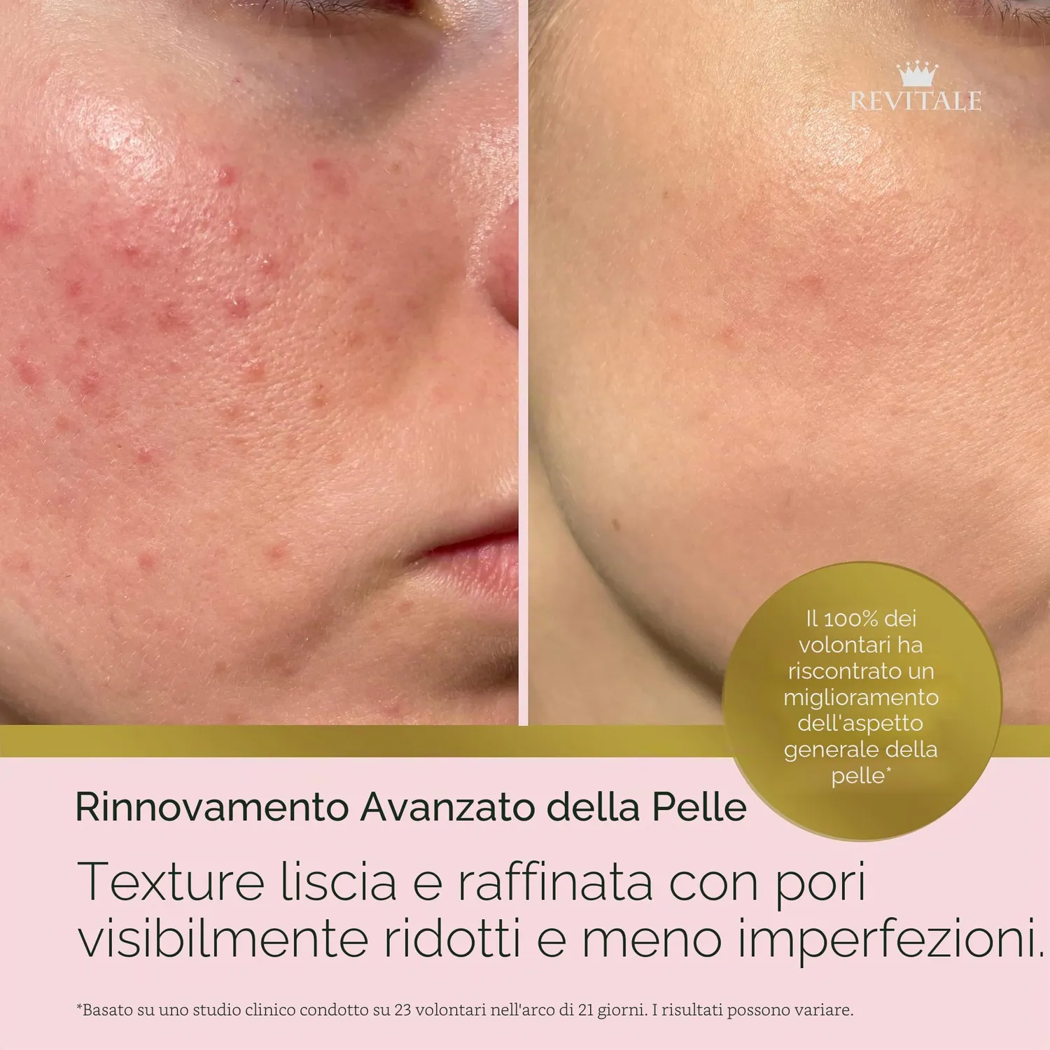 Revitale Advanced Acido Salicilico crema 80 g imperfezioni