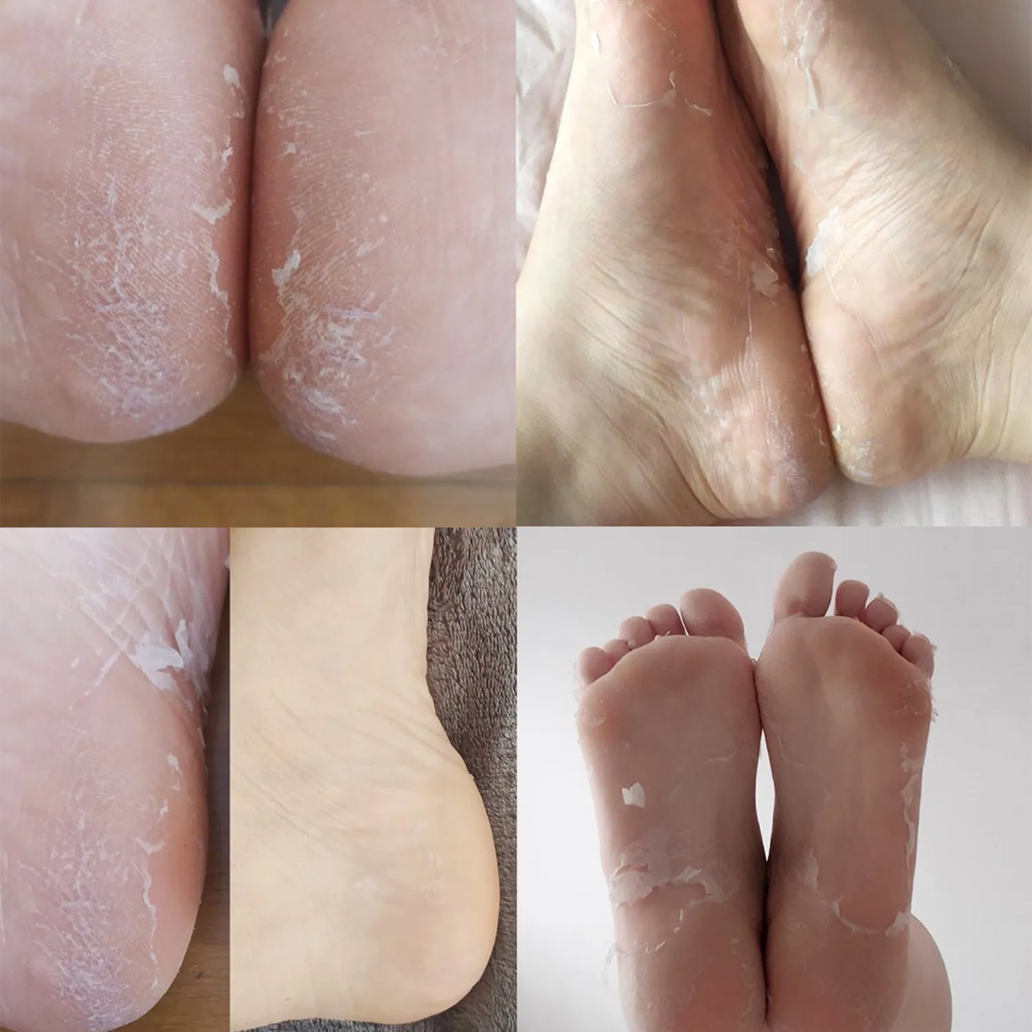 Iroha Nature peeling piedi calzini acido glicolico 1 paio