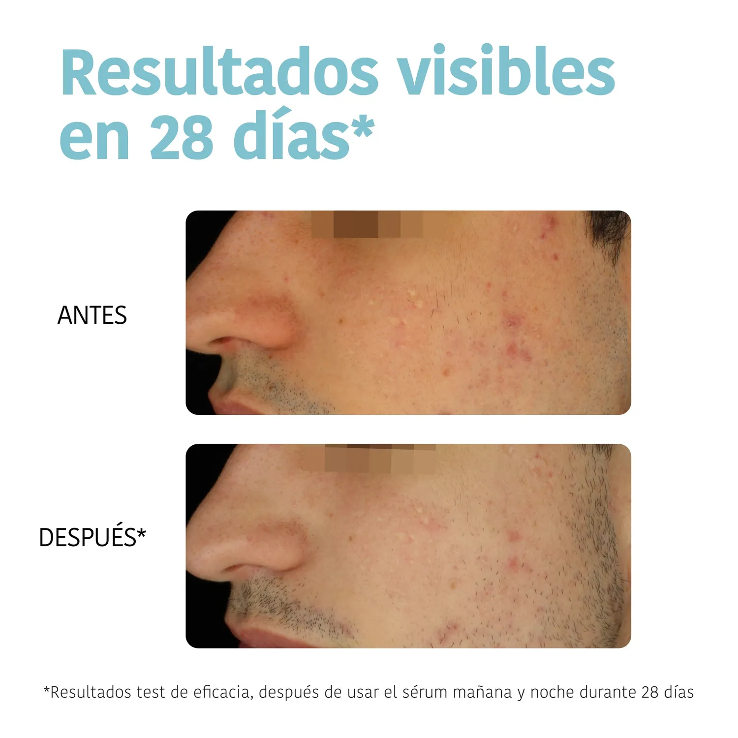 Irohanature Prevent & Correct Anti-Blemish siero acne niacinamide