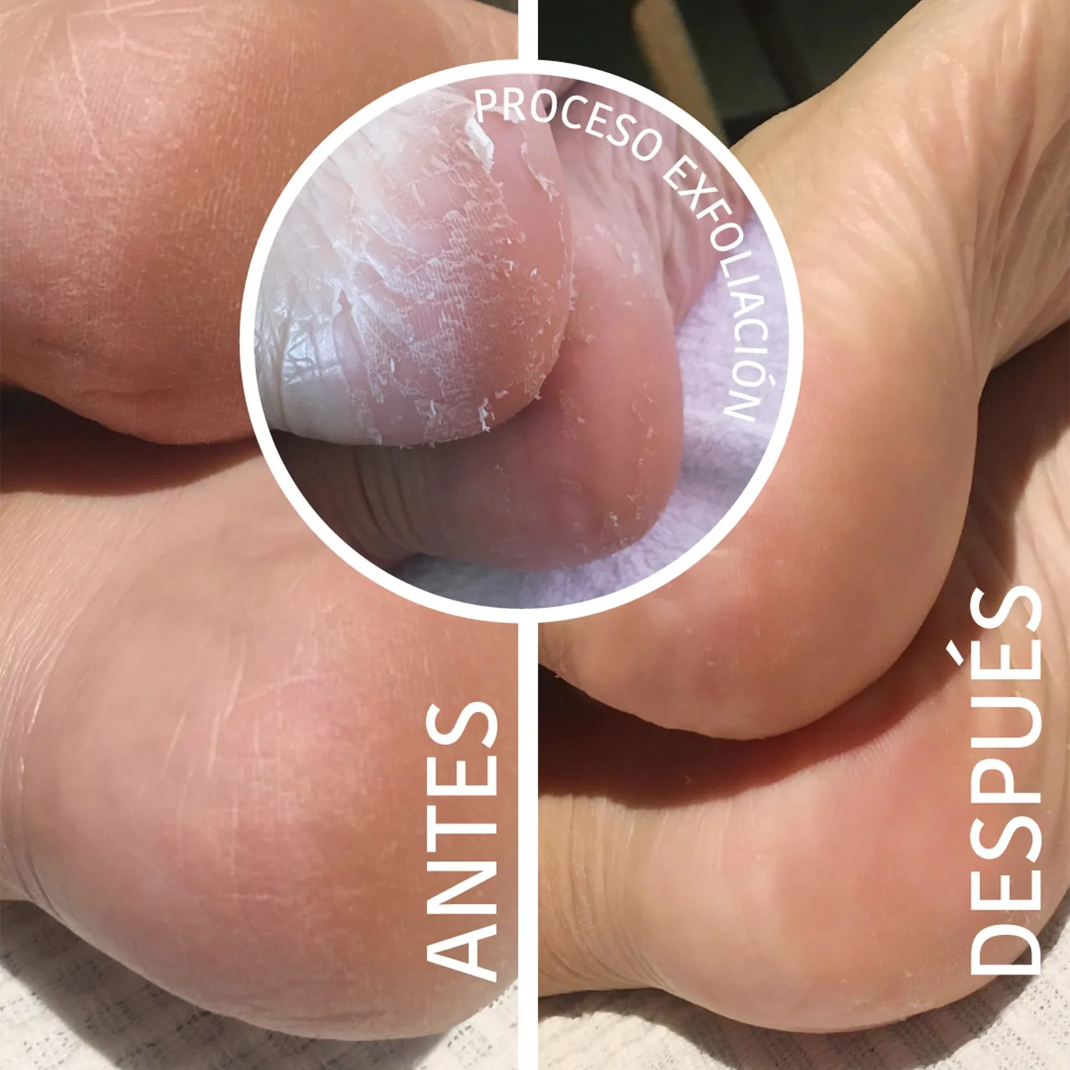 Iroha Nature peeling piedi calzini acido glicolico 1 paio