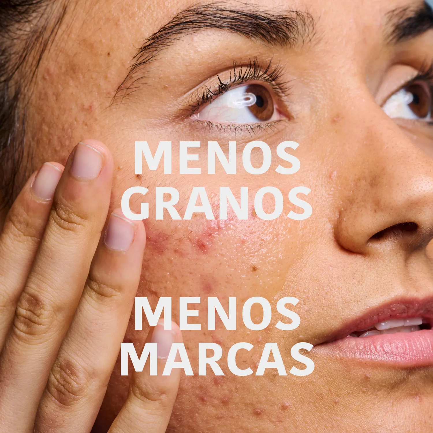 Irohanature Prevent & Correct Anti-Blemish siero acne niacinamide